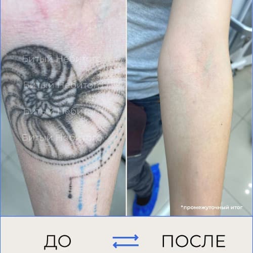 Удаление татуировки